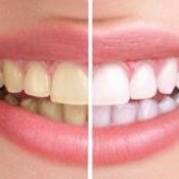 teeth-whitening-1-300x160